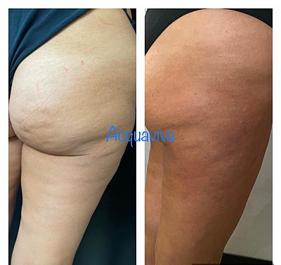 Trattamenti corpo Acquaviva