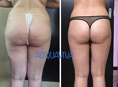 Trattamenti corpo Acquaviva