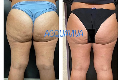 Trattamenti corpo Acquaviva