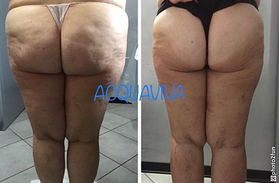 Trattamenti corpo Acquaviva