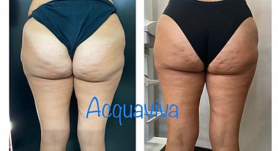 Trattamenti corpo Acquaviva
