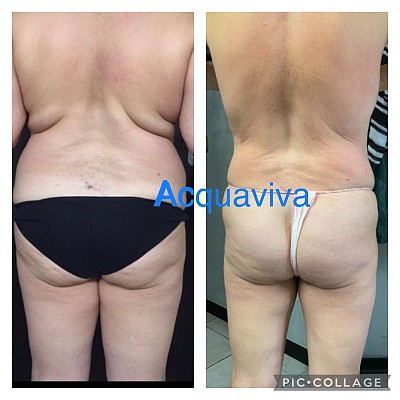 Risultati trattamenti corpo Acquaviva