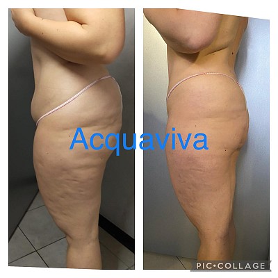 Risultati trattamenti corpo Acquaviva