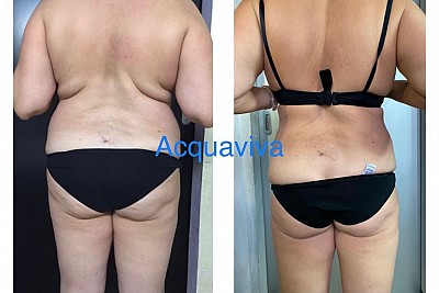 Risultati trattamenti corpo Acquaviva