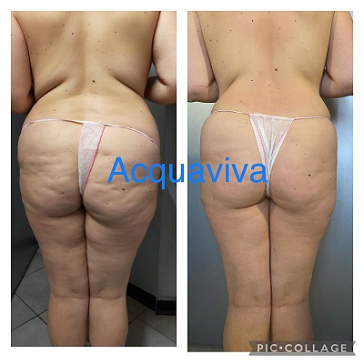 Risultati trattamenti corpo Acquaviva