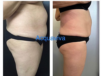 Risultati trattamenti corpo Acquaviva