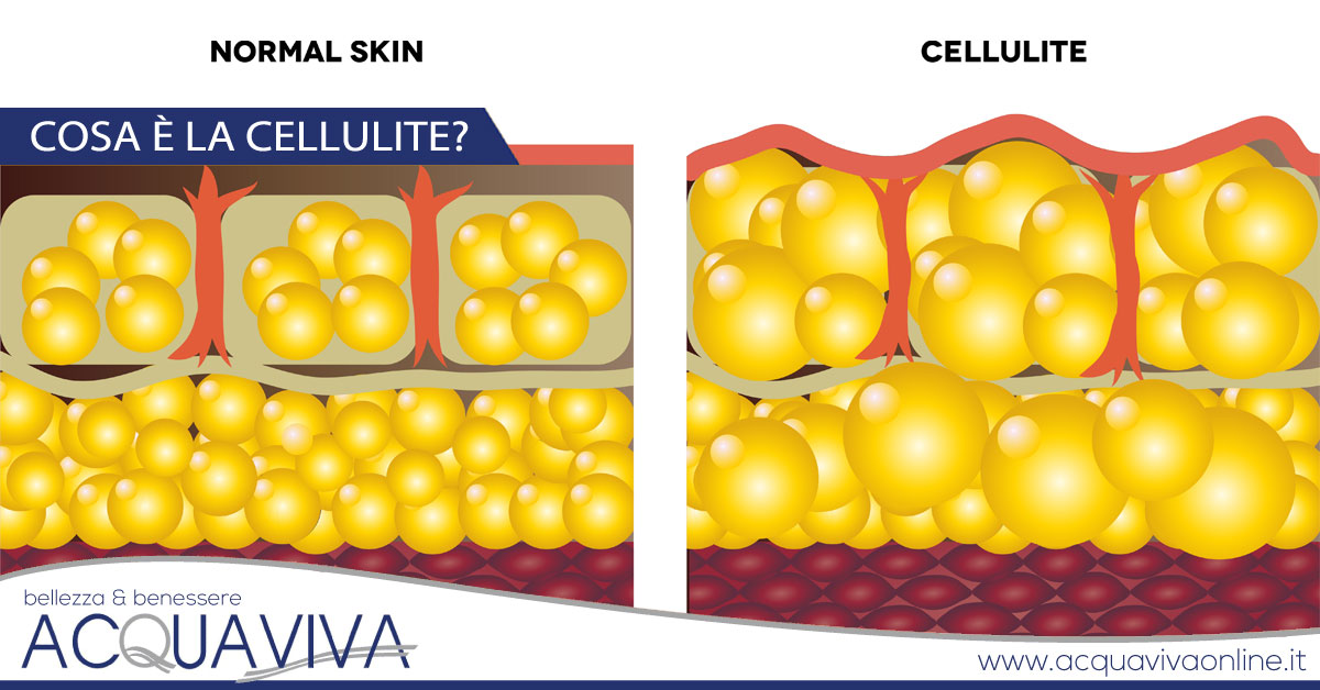 Cosa è la cellulite?