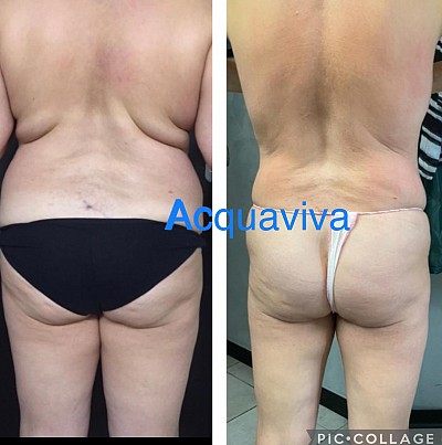 Risultati trattamenti corpo